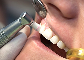 歯周治療・予防歯科